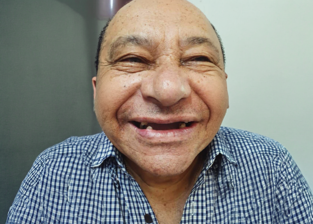 Dentes antes do tratamento de prótese